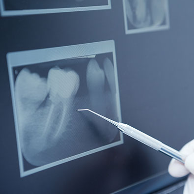Digital X-rays | Today's Dental